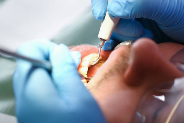 Best Emergency Tooth Extraction in Steele, AL